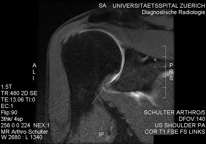 Shoulder MRI showing thickening near the inferior joint capsule