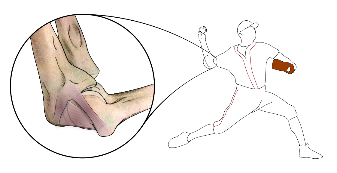 Illustration of a pitcher and the ulnar collateral ligament on the inner elbow