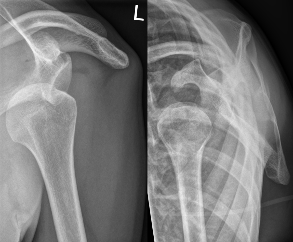 X-ray showing an anteroinferior dislocation of the humeral head